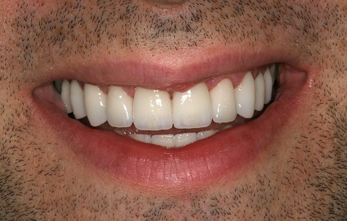 After dental treatment - Case 1